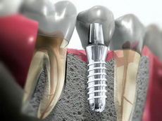 Имплантация зубов – возвращение улыбки
